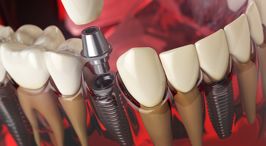 Implantes Dentales